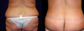 Posterior View - Circumferential Tummy Tuck After Massive Weight Loss