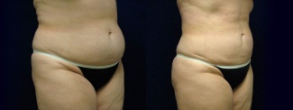 Right 3/4 View - Liposuction