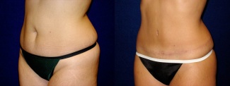 Left 3/4 View - Tummy Tuck After Pregnancy