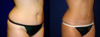 Right 3/4 View - Tummy Tuck After Pregnancy