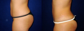 Left Profile View - Tummy Tuck After Pregnancy