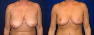 Frontal View - Breast Reduction