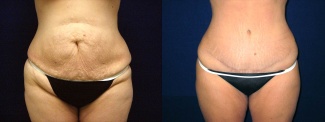 Frontal View - Tummy Tuck After Pregnancy