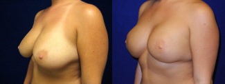Left 3/4 View - Breast Reconstruction