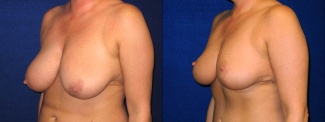 Left 3/4 View - Breast Reduction