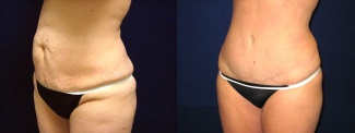 Left 3/4 View - Tummy Tuck After Pregnancy