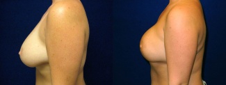 Right 3/4 View - Breast Reconstruction