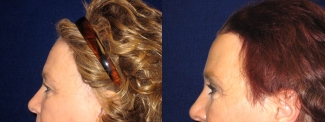 Left Profile View - Upper Eyelid Surgery with Browlift