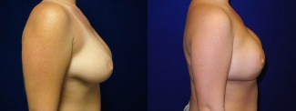 Right Profile View - Breast Reconstruction