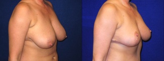 Right 3/4 View - Breast Reduction