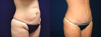 Right Profile View - Tummy Tuck After Pregnancy