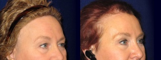 Right 3/4 View - Browlift with Upper Eyelid Surgery