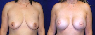 Frontal View - Breast Reconstruction