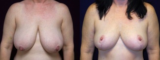 Frontal View - Breast Reduction