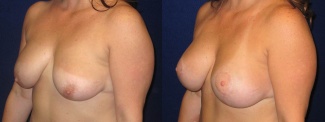 Left 3/4 View - Breast Augmentation with Lift - Silicone Implants