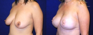 Left 3/4 View - Breast Reconstruction