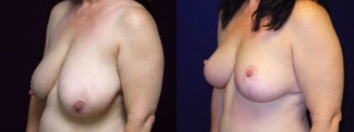 Left 3/4 View - Breast Reduction