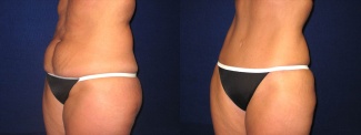 Left 3/4 View - Tummy Tuck After Pregnancy