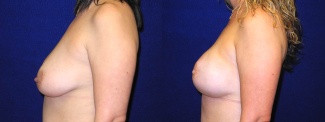 Left Profile View - Breast Reconstruction