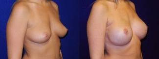 Right 3/4 View - Breast Reconstruction