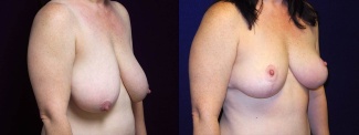 Right 3/4 View - Breast Reduction