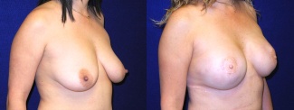 Right 3/4 View - Breast Reconstruction