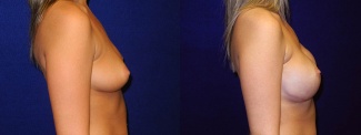 Right Profile View - Breast Reconstruction