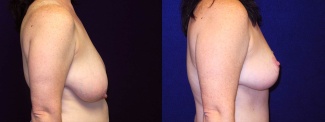 Right Profile View - Breast Reduction