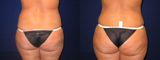Back View - Tummy Tuck After Pregnancy