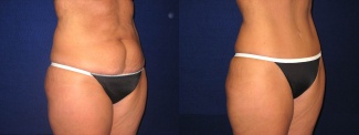 Right 3/4 View - Tummy Tuck After Pregnancy