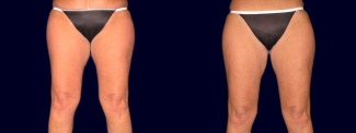 Frontal View - Tummy Tuck After Pregnancy