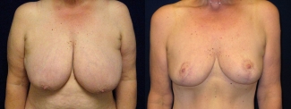 Frontal View -  Breast Lift Reduction