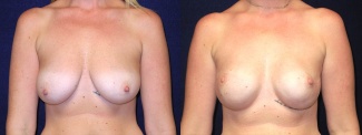 Frontal View - Breast Reconstruction