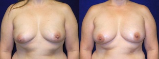 Frontal View - Breast Reconstruction