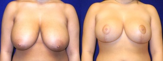 Frontal View - Breast Reduction