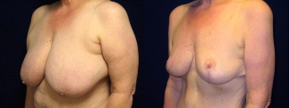 Left 3/4 View - Breast Lift Reduction