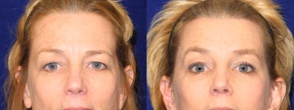 Fontal View - Browlift with Upper Eyelid Surgery