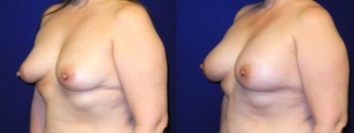 Left 3/4 View - Breast Reconstruction