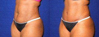 Left 3/4 View - Tummy Tuck After Pregnancy