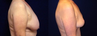 Right Profile View - Breast Lift Reduction