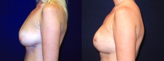 Left Profile View - Breast Reconstruction