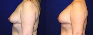 Left Profile View - Breast Reconstruction