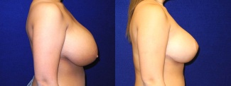 Right Profile View - Breast Reduction