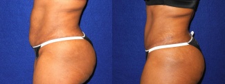 Left Profile View - Tummy Tuck After Pregnancy