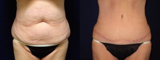 Frontal View - Abdominoplasty