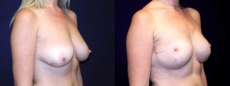 Right 3/4 View - Breast Reconstruction