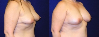 Right 3/4 View - Breast Reconstruction