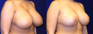 Right 3/4 View - Breast Reduction