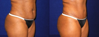 Right 3/4 View - Tummy Tuck After Pregnancy