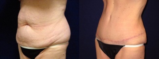 Left 3/4 View - Abdominoplasty